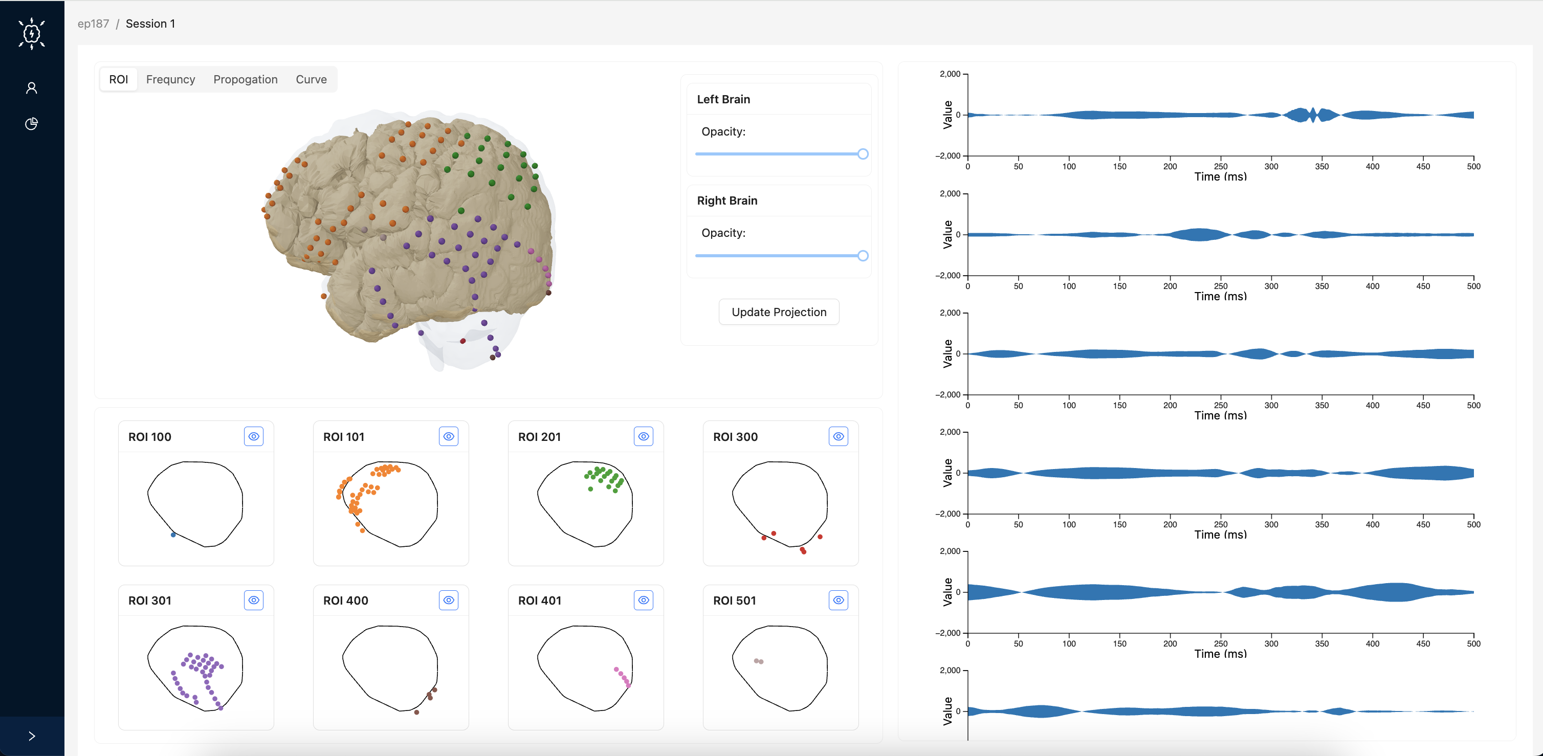 Electrical activity visualization analysis tool for diagnosing epileptic seizures and propagation